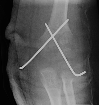 Supracondylar fracture cross K wires